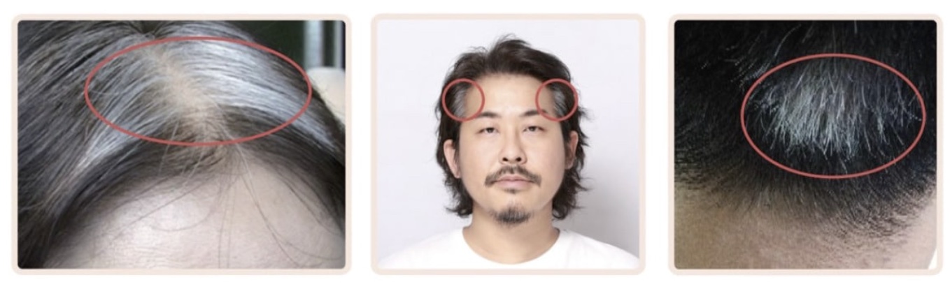 Hallide juuste asukoht peas reedab siseorganite tervise